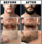 Kit Minoxidil Kirkland 5% x2 + 2 Dermaroller | Crecimiento Capilar y Barba