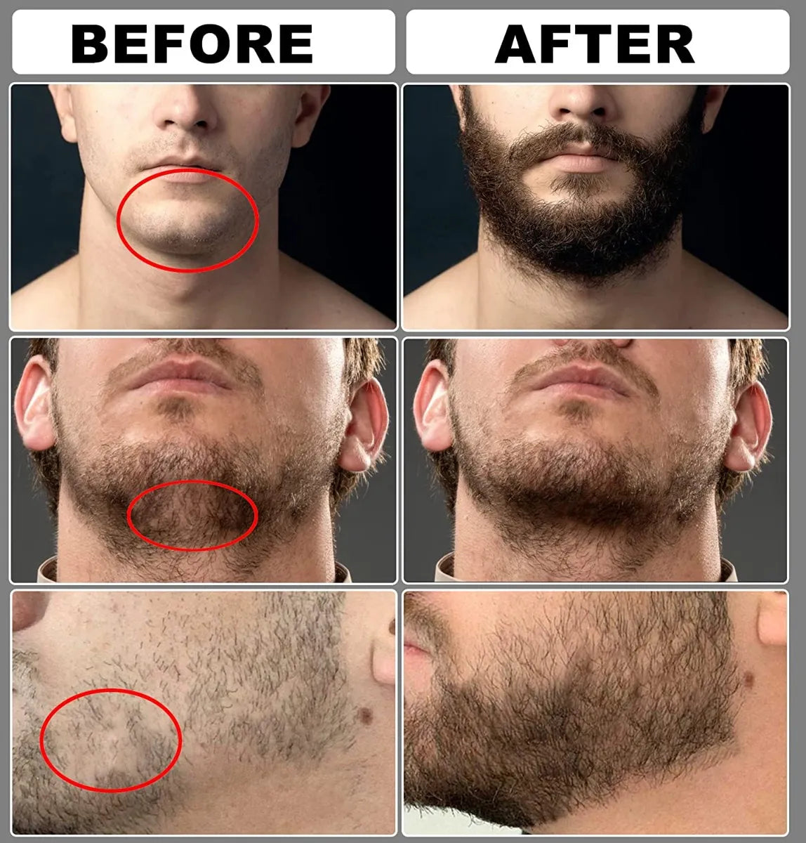 Kit Minoxidil Kirkland 5% x2 + 2 Dermaroller | Crecimiento Capilar y Barba